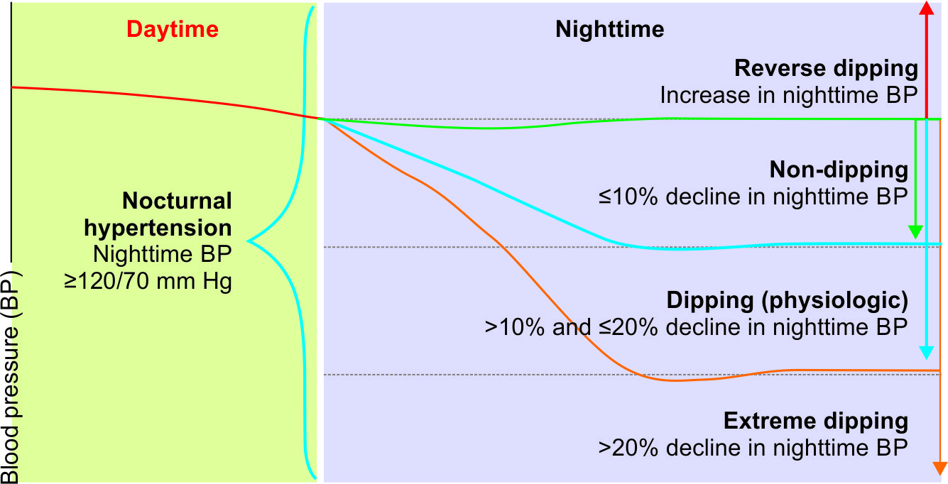 Optimizing the Diagnosis and Management of Nocturnal Hypertension: An  Expert Consensus from India